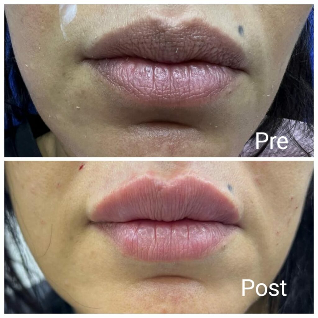 Lip filler